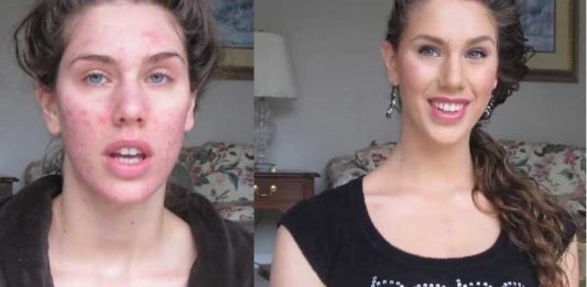 cacher-ses-boutons-grace-au-maquillage tuto